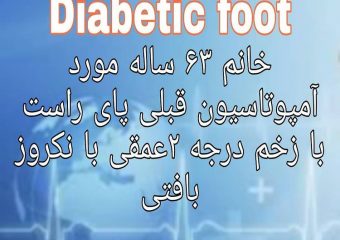 آمپوتاسیون قبلی پای راست